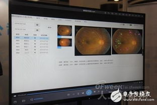 AI賦能眼科醫療 至真互聯以網絡技術研發推動行業革新